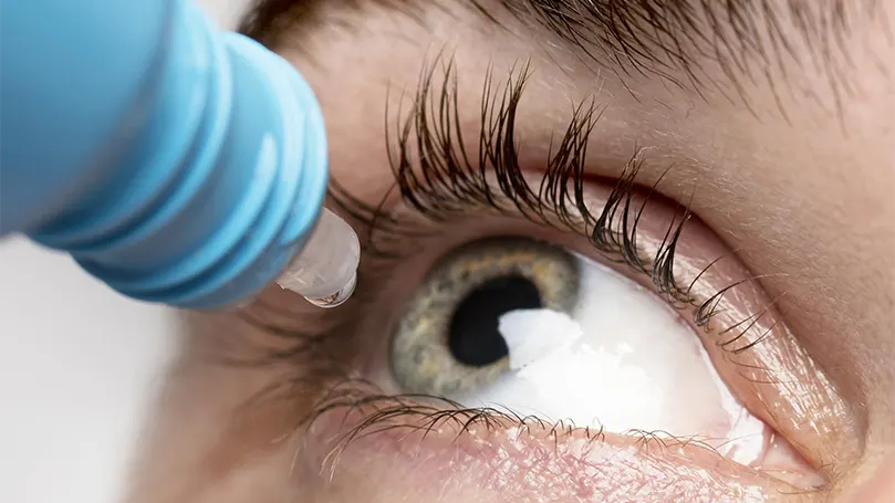 Image d'une personne déposant un collyre dans son œil.