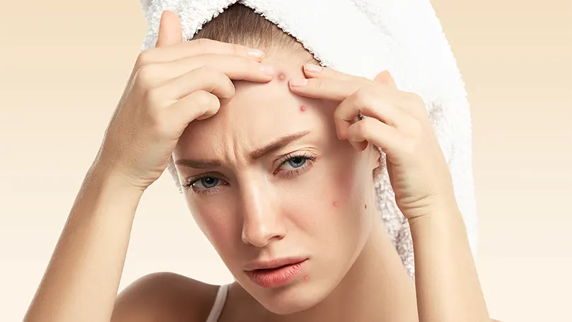 Image d'une femme pressant des acnés sur son visage.