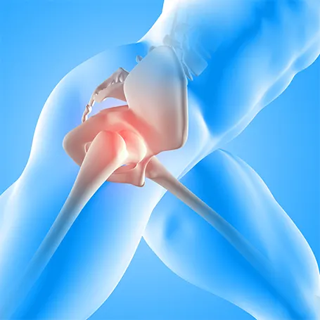 une illustration de la cause de la douleur à la hanche