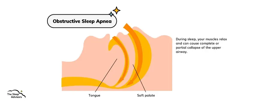 Infographie sur l'apnée obstructive du sommeil