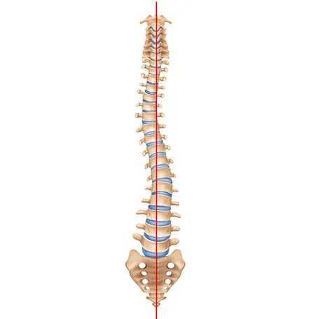 Image de la colonne vertébrale en cas de scoliose